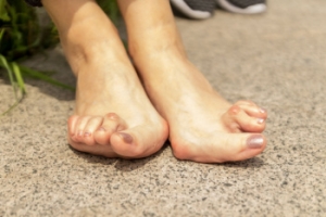 Rheumatoid Arthritis and Foot Health