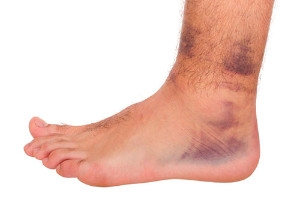 Causes and Care of Foot Bruises