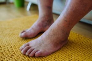 Foot-Related Complications From Diabetes