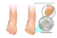 Causes and Types of Toenail Fungus