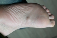 Definition of a Plantar Fibroma